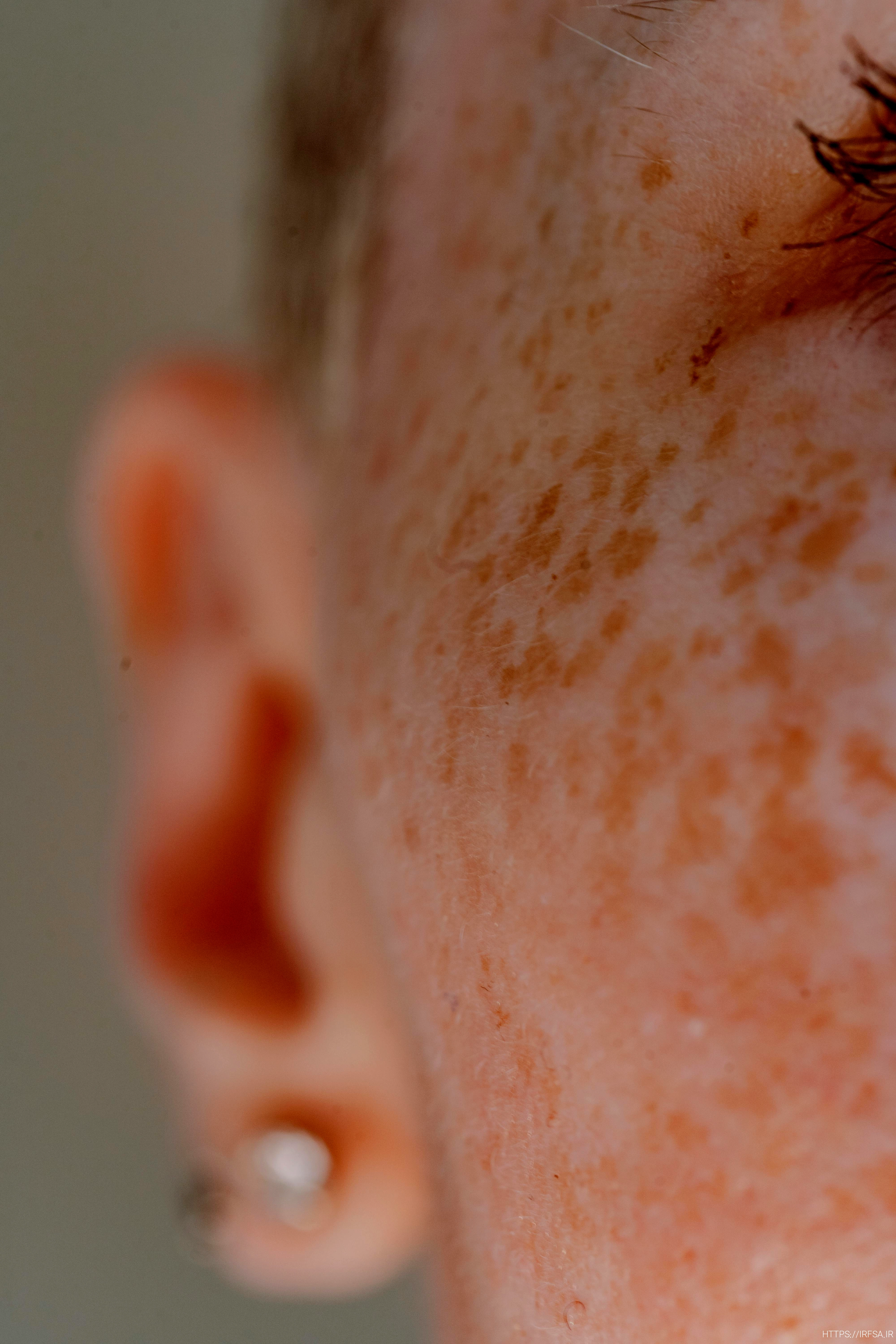 facial hypotherapy